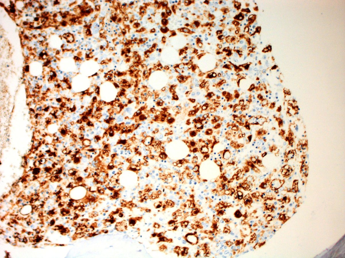 Macrophages demonstrating increased hemophagocytosis, highlighted on CD68 staining (Immunoperoxidase, 400x)
